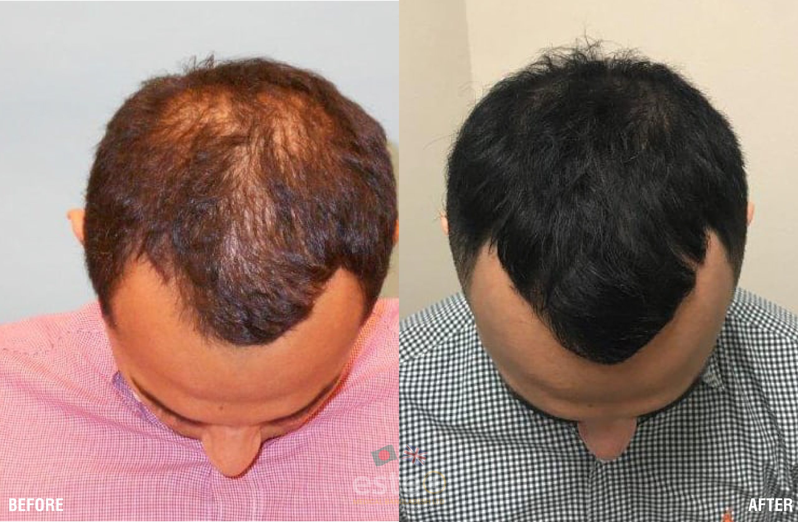 PRP-Hair-3-01-scaled