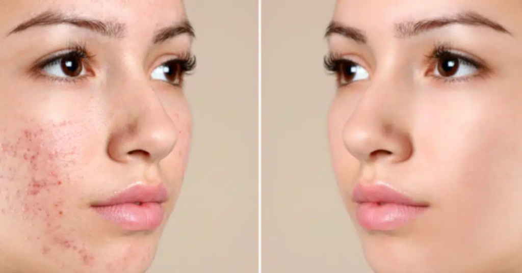 Microneedling with PRP in New Braunfels: The Ultimate Skin Rejuvenation Solution