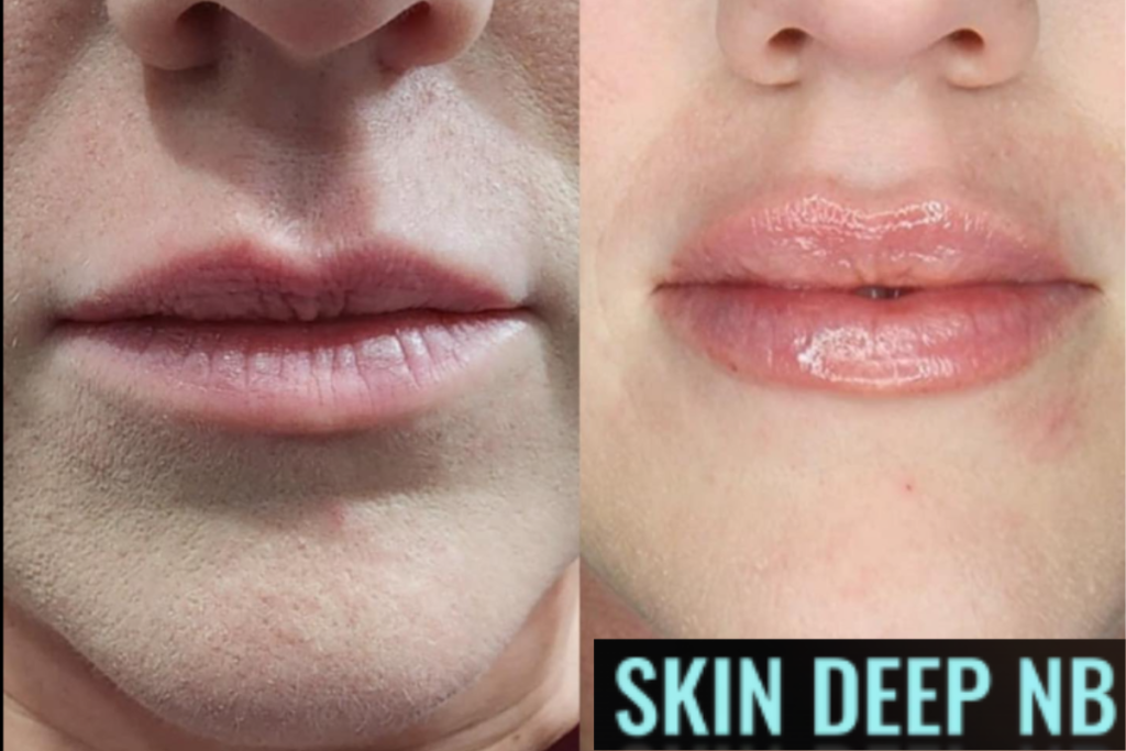 Lip Fillers in Canyon Lake & New Braunfels