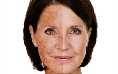 How to Get Rid of Sun Damage in Texas: Top Med Spa Treatments That Actually Work (Canyon Lake & New Braunfels)